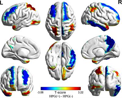 Gray Matter Differences Between Premature Pubertal Girls With and Without the Reactivation of the Hypothalamic—Pituitary-Gonadal Axis